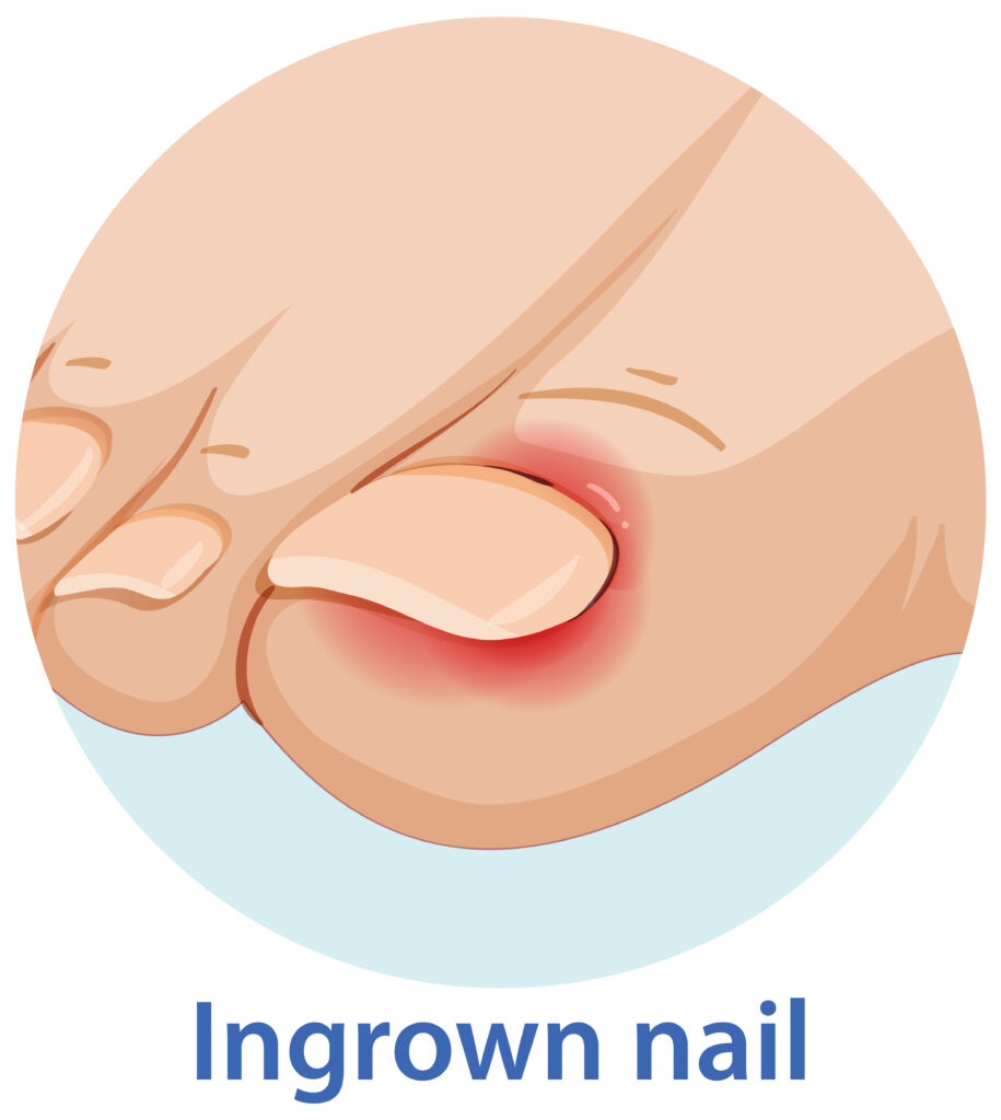 Illustration of an ingrown toenail causing redness and inflammation
