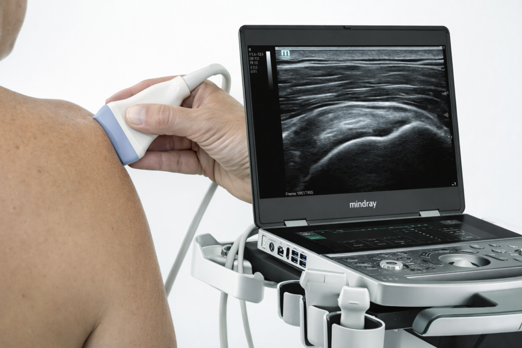 Musculoskeletal ultrasound examination of the shoulder performed in an orthopedic clinic, showing real-time ultrasound imaging on the monitor