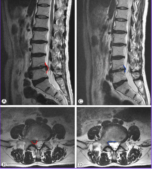 MRI images showing spontaneous resorption of a lumbar herniated disc after conservative treatment