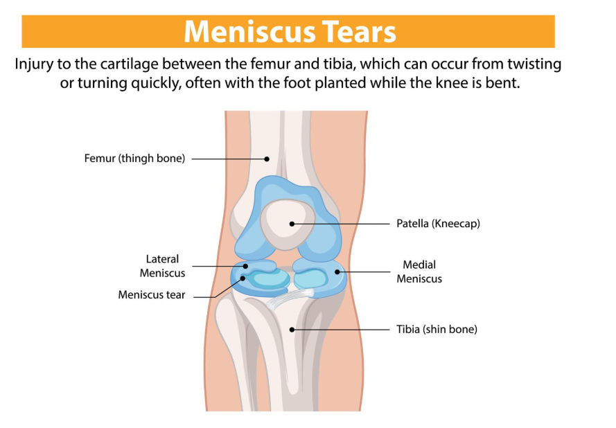 Illustration of a knee joint showing a meniscus tear between the femur and tibia, with labeled anatomical structures