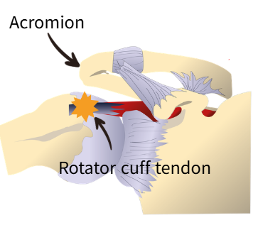 Anatomical illustration showing shoulder impingement, where the rotator cuff tendon is compressed beneath the acromion