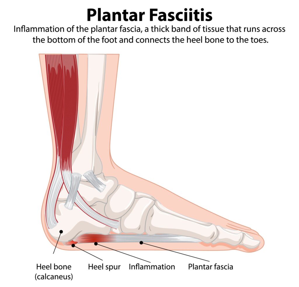 Illustration showing the plantar fascia structure and the area of heel pain in plantar fasciitis